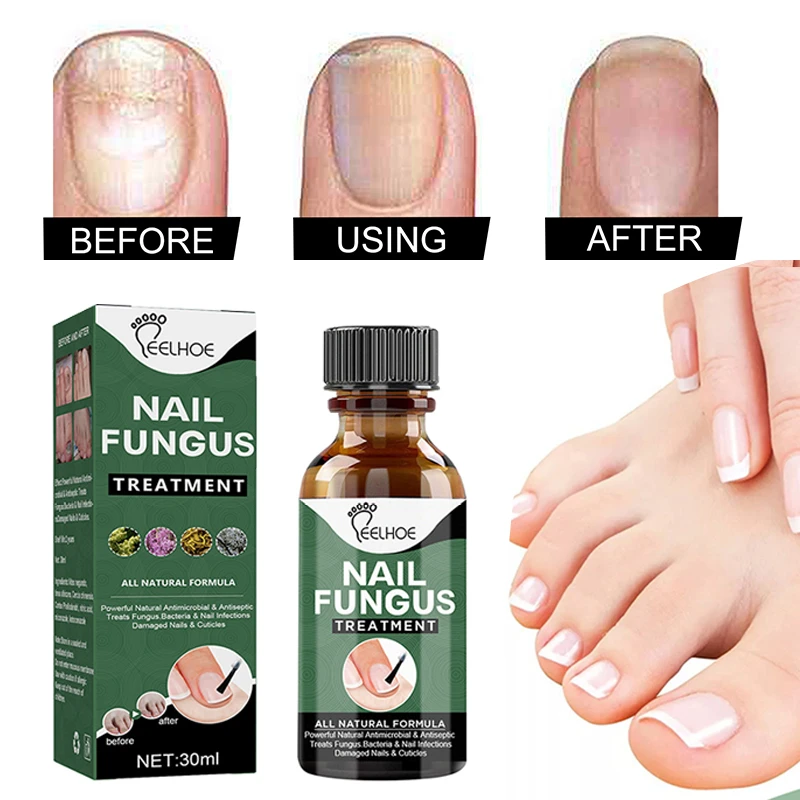 Nail Repair Serum Nail Fungal Treatment Serum Onychomycosis Paronychia Antifungal Nail