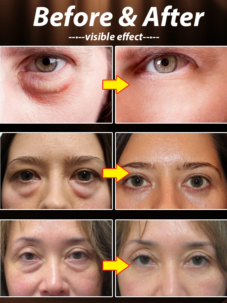 Eye Cream Eye Bags Disappear Care