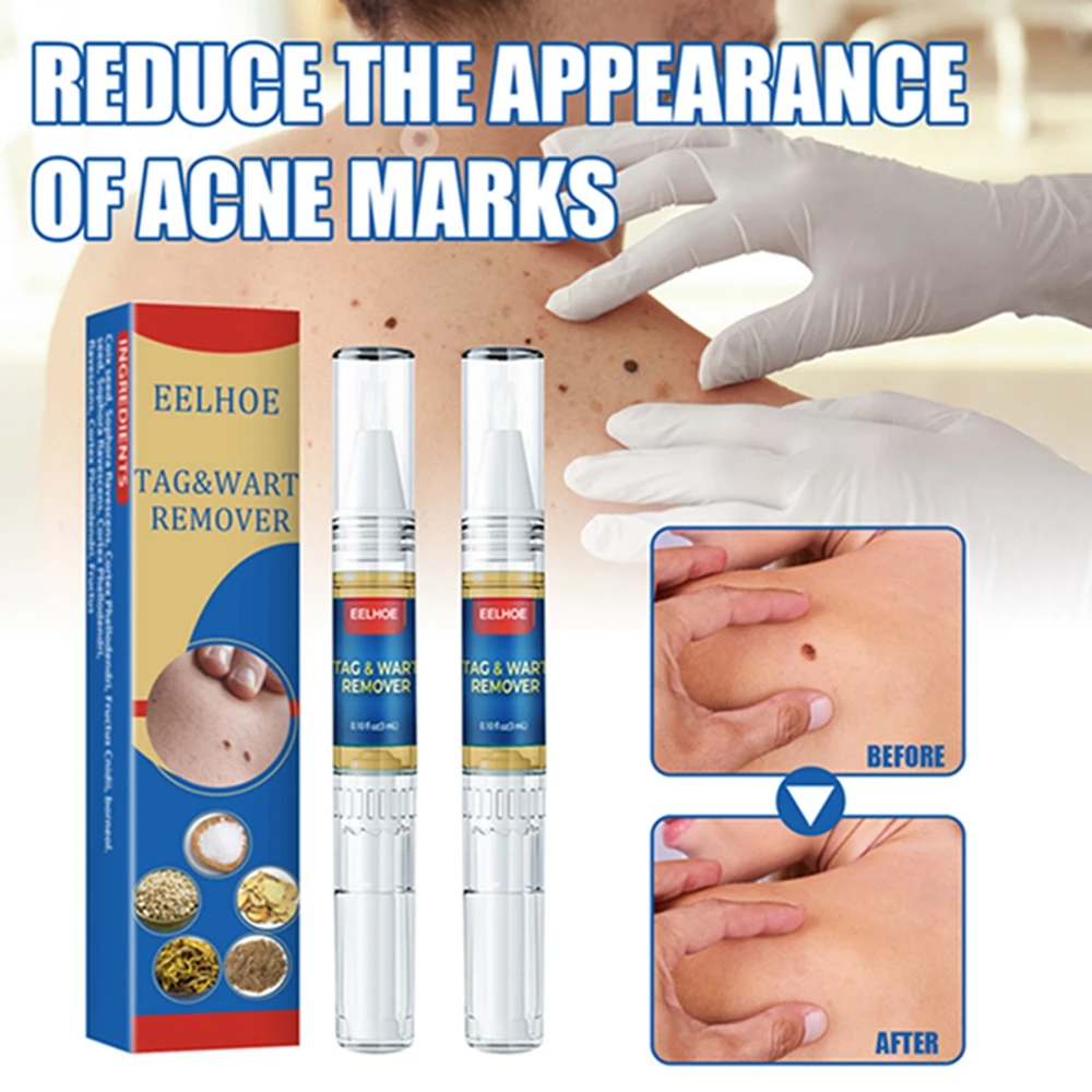 New Wart Removal Mole Liquid Pen Treatment Papillomas Removing Skin