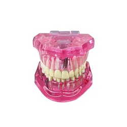 Dental Restoration & Disease Analysis Teaching Model (Pink)