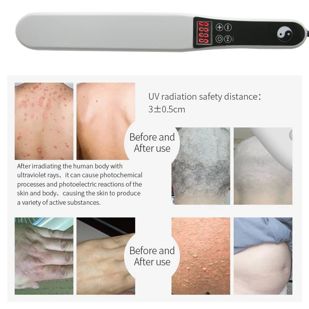 311nm Ultraviolet Phototherapy Instrument use UVB Philips Lamp UV for Vitiligo Psoriasis White Spots Skin Disease - Image 3