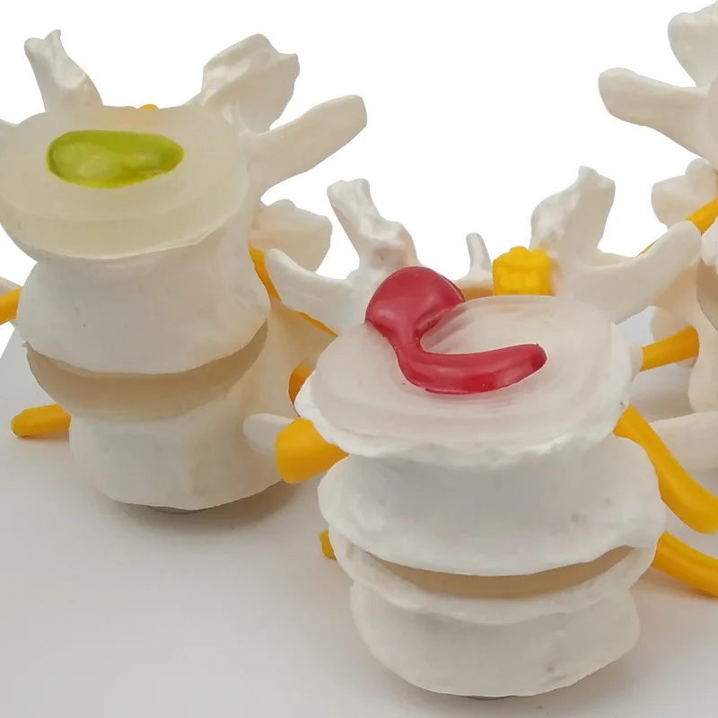 Anatomical Models 4-stage Pathological Human Lumbar Spine Anatomy Model Medical Science Teaching Resources