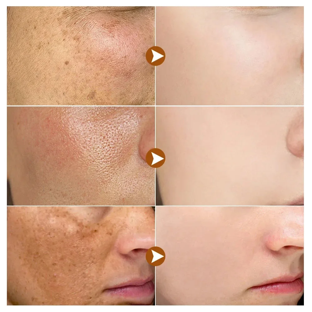 Powerful Dark Spots Remover Whitening Serum Face Freckle Melanin Correcting Anti Pigmentation Brighten Skin Beauty Care Essence 2