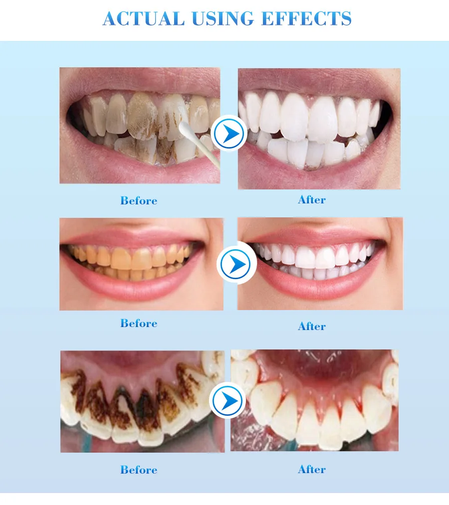 Dental Whitening Kit Whiten Teeth Bleach Gel Oral Care Quickly Remove Tooth Stains Dr. Whitening Clean Denxy Dentistry Material