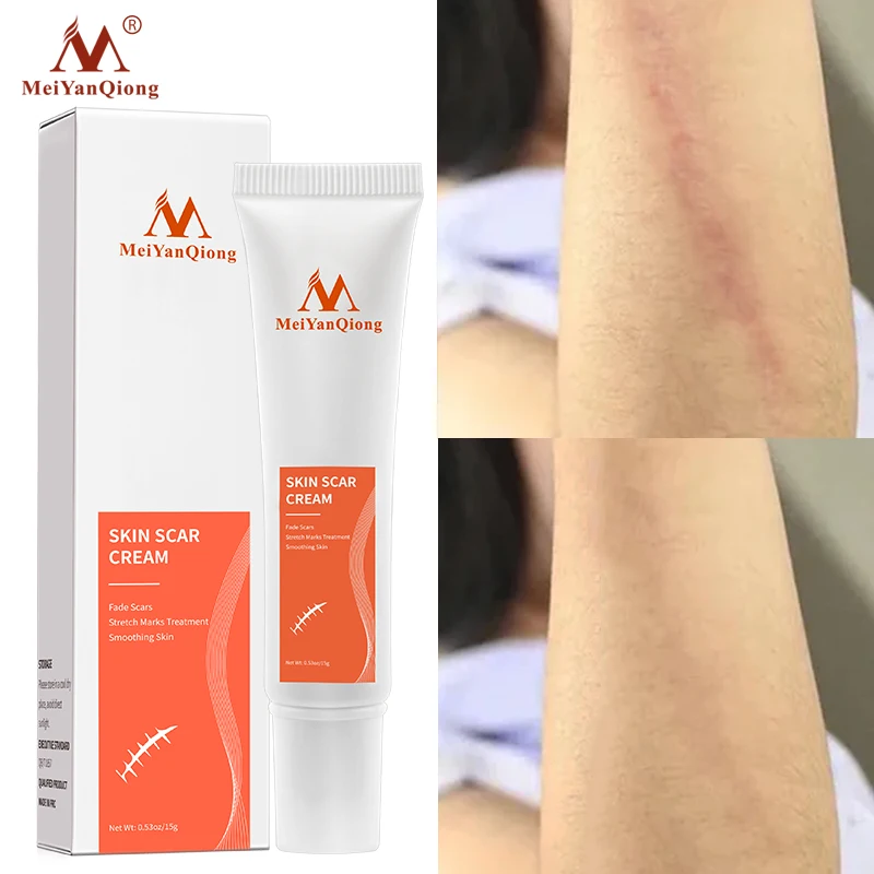 Acne Fade Scars Cream Skin Repair Face Cream Acne Spots Acne Treatment