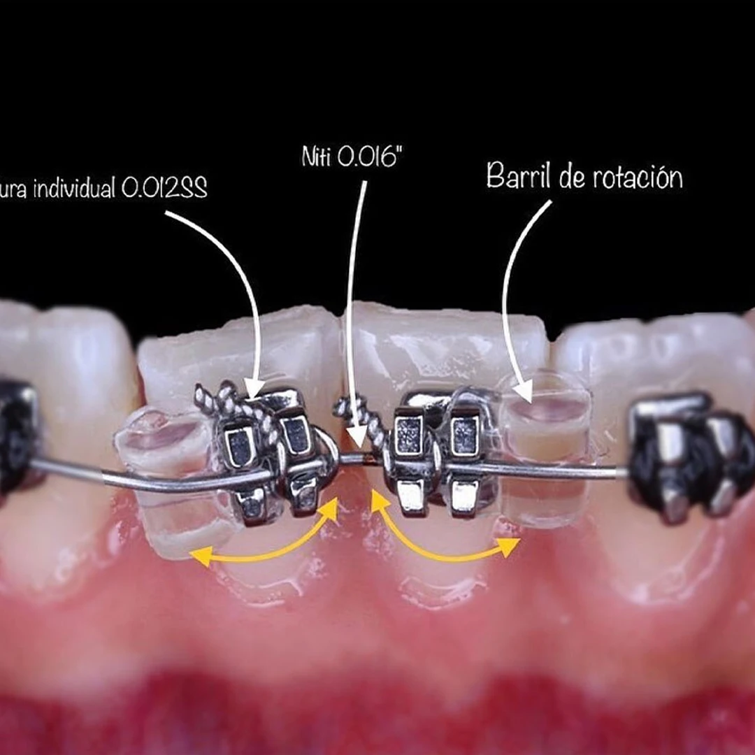 Cunei Elastici di Rotazione – Orthodontics High Design