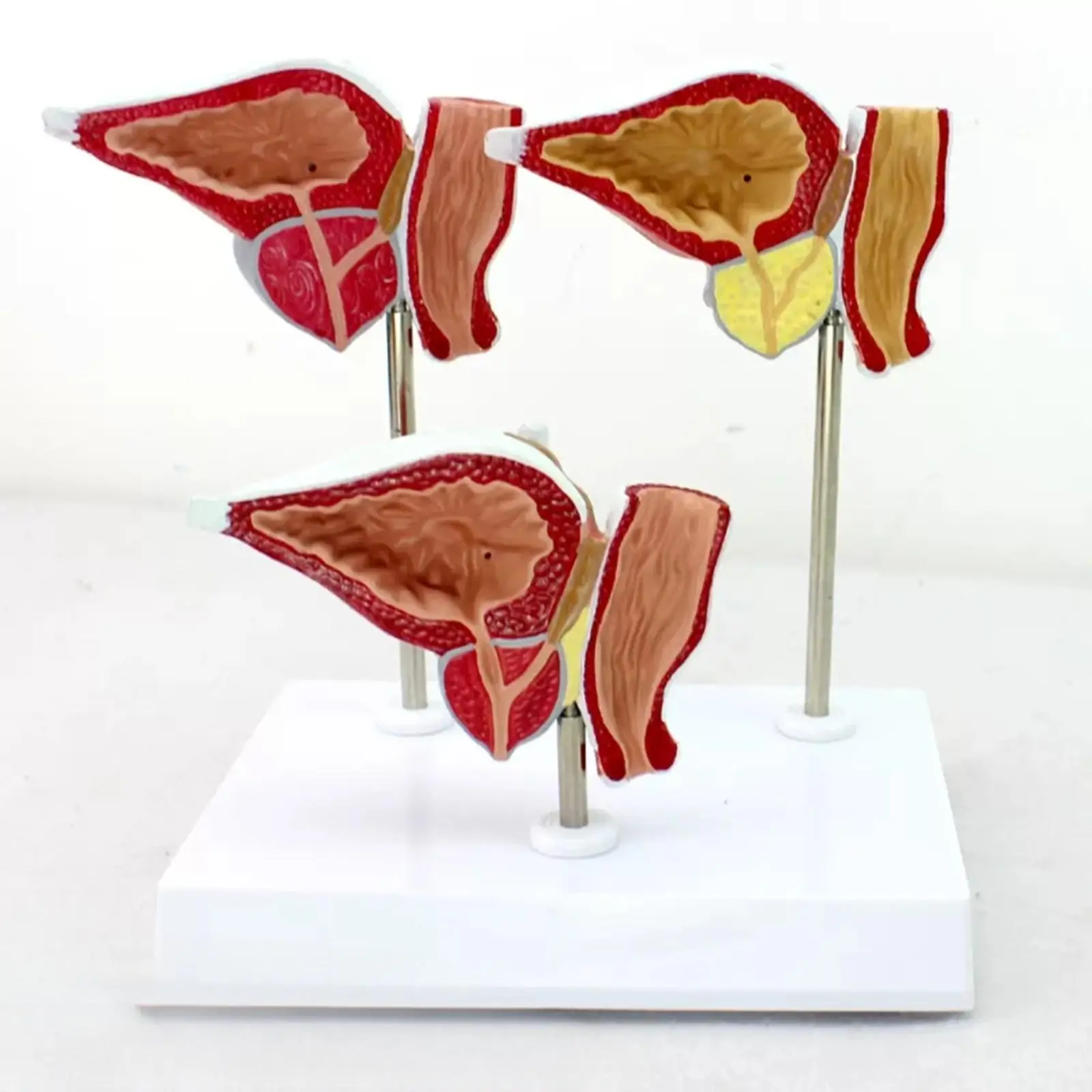 

Human Prostate Normal Hyperplasia Carcinoma Model Medical School
