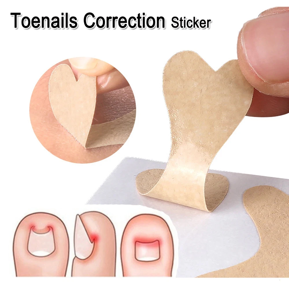 Jemeesen Ingrown Toenail Corrector Sticker Paronychia Treatment Pedicure Foot Orthodontic Toe Thumb Nail Care Patches Foot Care
