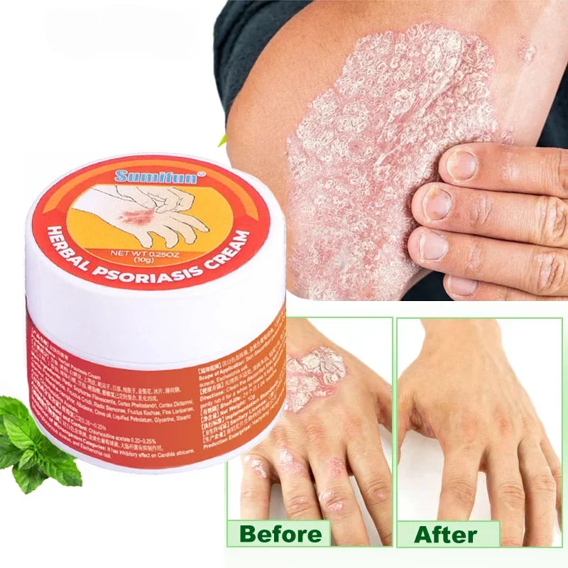 Herbal Skin Cream for Psoriasis Dermatitis