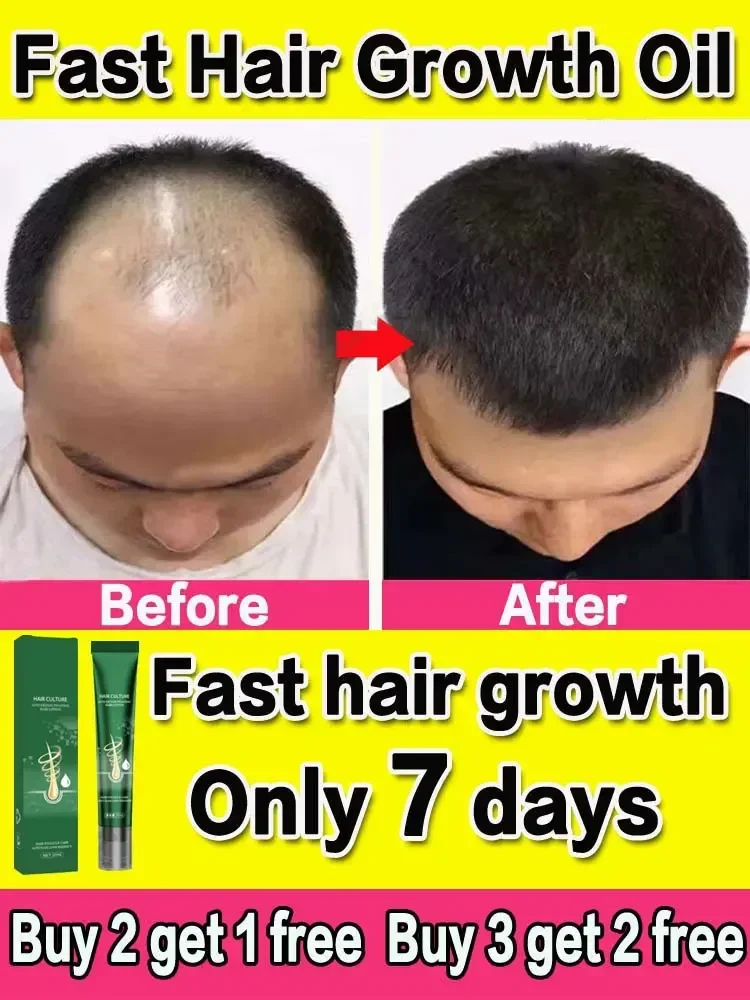 Hair Growth Oil Hair Growth Oil Fast Growing Hair Effective Essential Baldness Repair Hereditary Anti Postpartum Seborrheic Loss Products