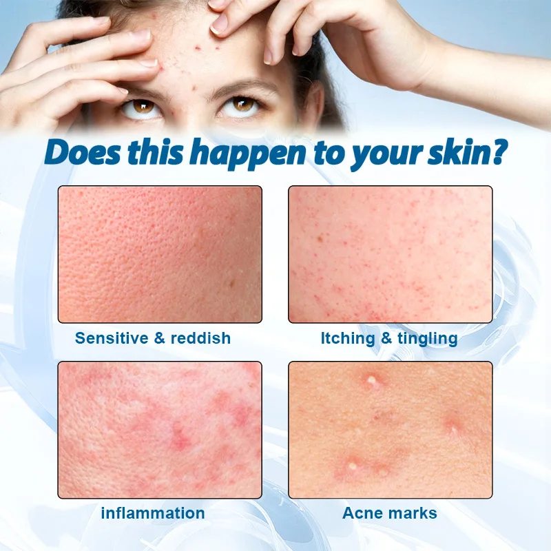 Oligopeptide Anti Acne Face Serum EGF Acne Treatment Essence Diminish Pigmentation Moisturizing Skincare Repair Skin Barrier 5