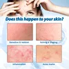 Oligopeptide Anti Acne Face Serum EGF Acne Treatment Essence Diminish Pigmentation Moisturizing Skincare Repair Skin Barrier 5