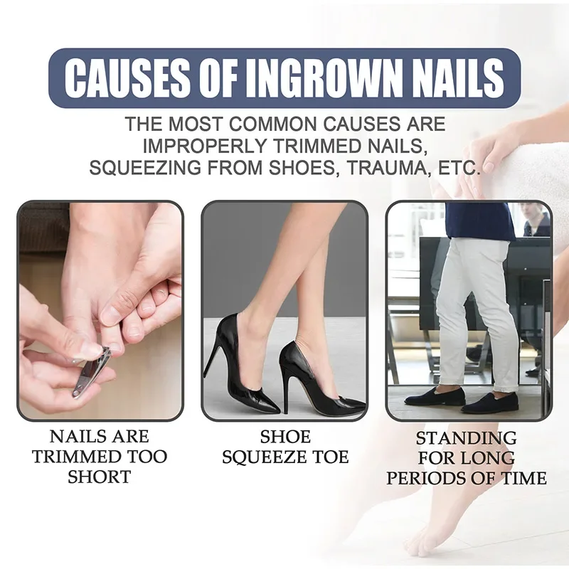 Toenailcare Removal Paronychia Oil Ingrown Toenail Treatment U&ntilde;as Renewal Liquid Bad Nail Thicken Nail Soft Repair Solution manicure pedicure tools nail fungus remover