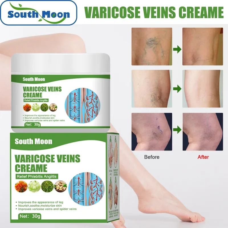 

Sdattor Varicose veins ointment leg vein bulge relief cream relieve red blood silk vasculitis phlebitis spider pain Massage trea