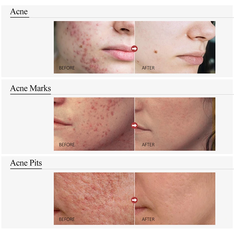 Salicylic Acid Acne Treatment Serum Dark Spots Remover Hyaluronic Acid Facial Serum Skin Care Beauty Cosmetics