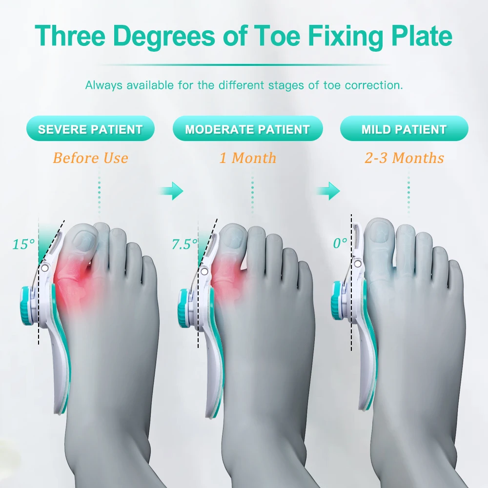 MERALL Adjustable Hallux Valgus Toe Correction Foot Care Tool Toe Seperator Bunion Corrector For Women Orthopedic Foot Massager