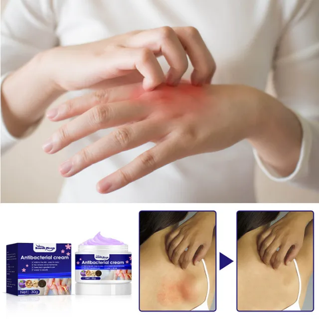 Herbal Psoriasis Cream Dermatitis Eczema Treat Ointment 5