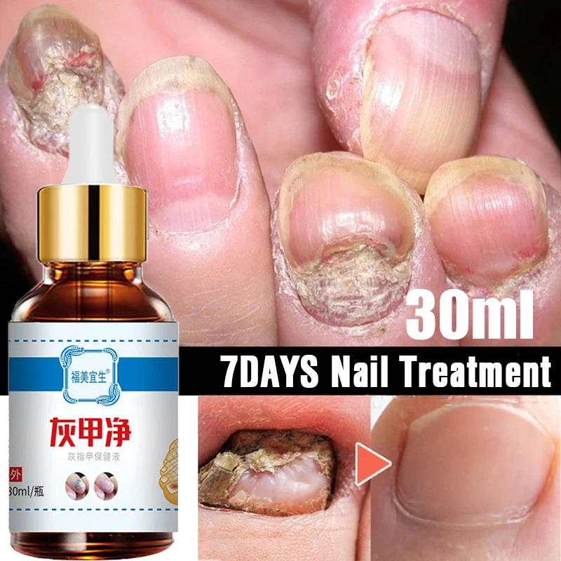 7DAYSRepairNailFungusTreatmentEssenceFootCareSerumToeNails