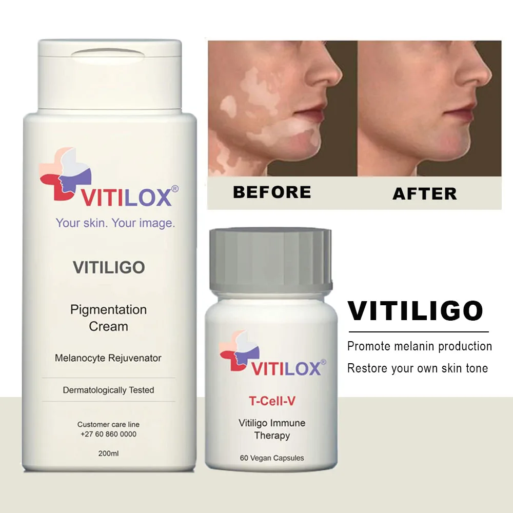 Vitiligo vitilox пигментация меланоцит