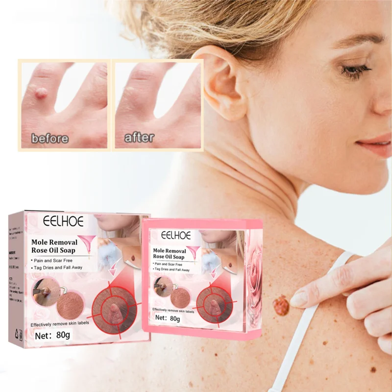 

80g Skin Tag Remover Soap Handmade Soap Whitening Moisturizing Remove Acne Clean Bath Soap Rose Cleaning Soap For Skin Care