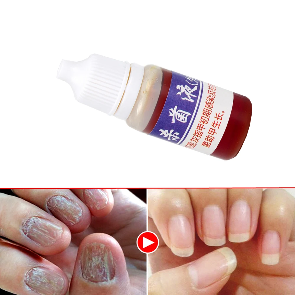Nail Fungus Remover Anti Infection Fungal Nail Treatment Liquid Gel