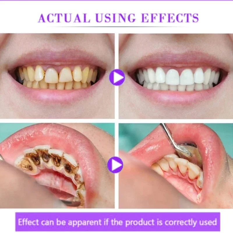 Рисунок 2 - Верхняя зубная паста для отбеливания зубов