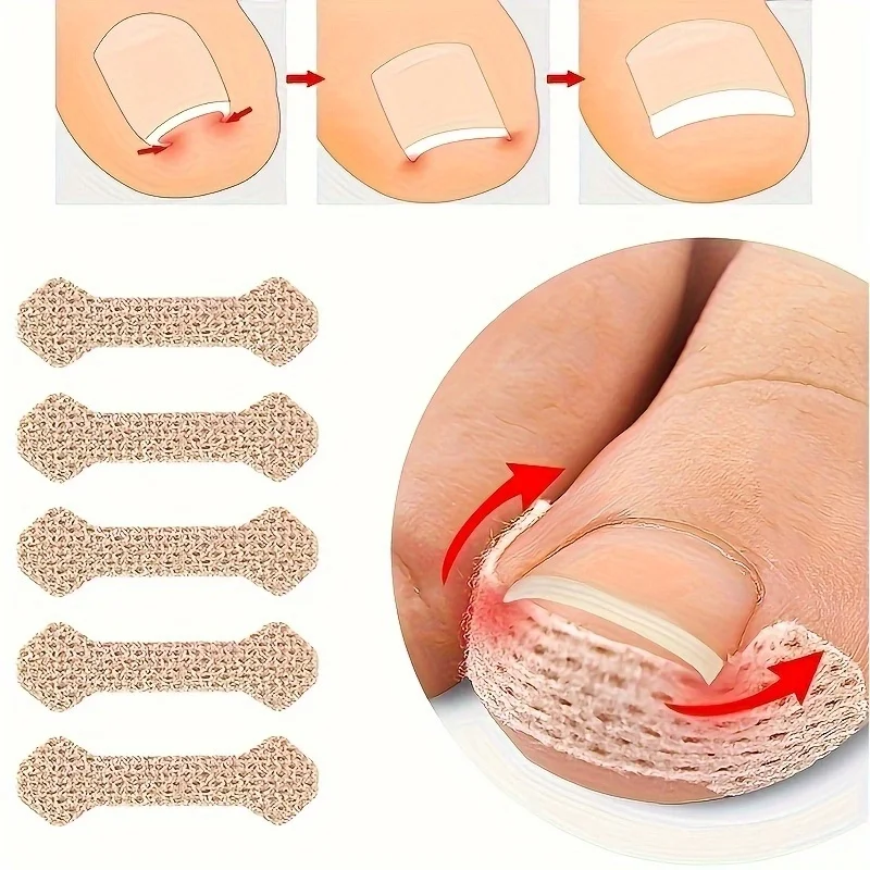 Ingrown Paronychia Toenail Corrector Strips Anti F 10pcs