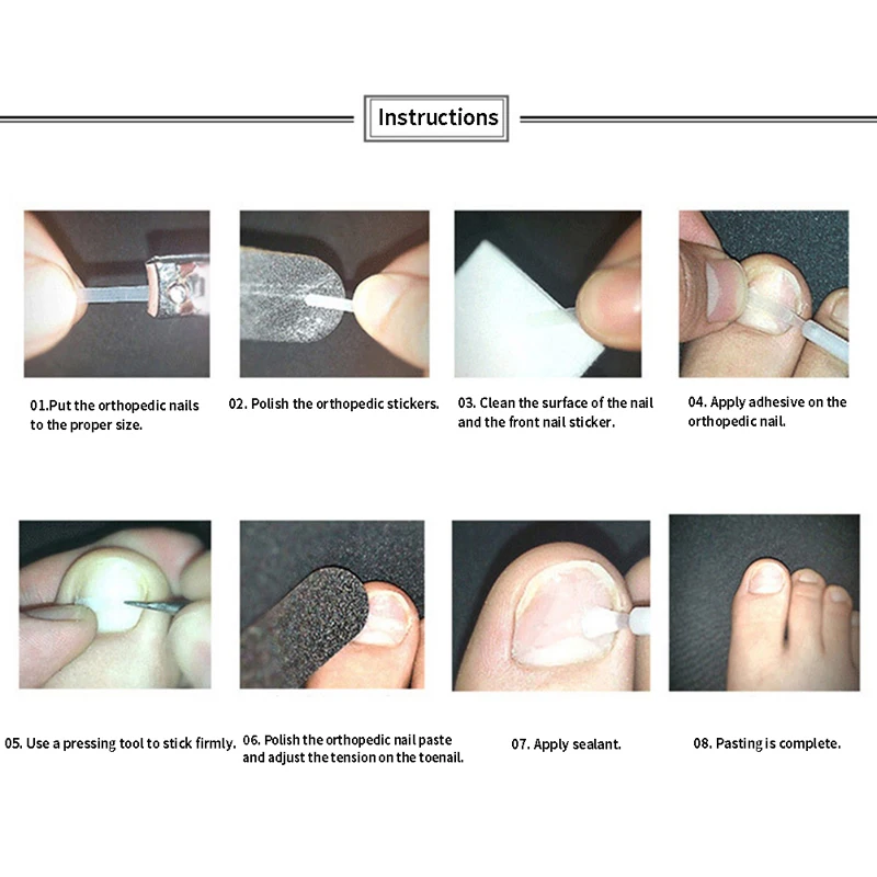 alt="An Ingrown Toenail Correction Tool with 10pcs Elastic Patch Stickers and Straightening Clips.