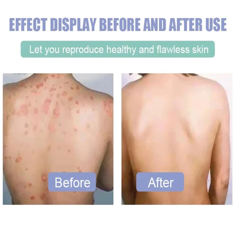 10g ZB Psoriasis cream treating eczema dermatitis antibacterial ointment urticaria natural plant skin itching repair pain relief cream