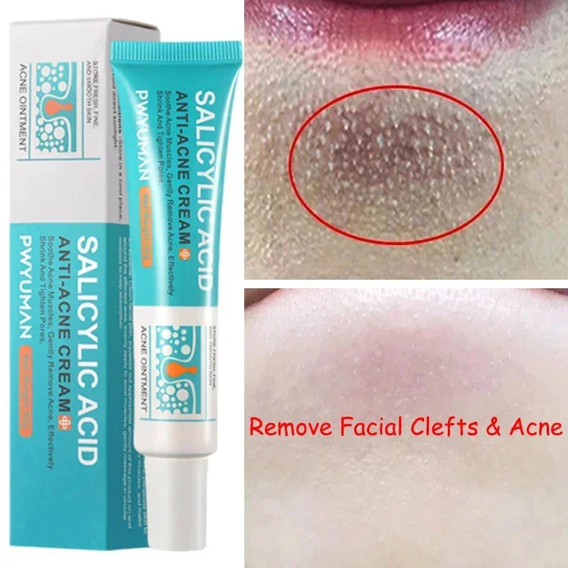 

Salicylic Acid Pore Shrinking Cream Quick Eliminate Large Pores Remove Blackehead Tighten Repair Face Smooth Skin Care Products