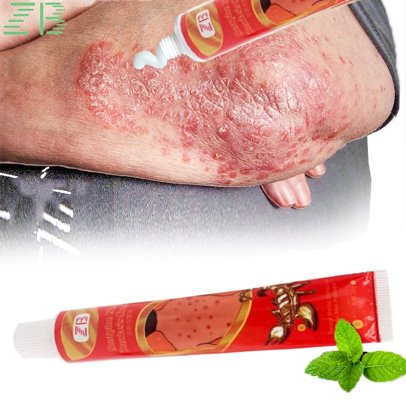 

20g Natural Psoriasis Ointment Dermatitis And Eczema Medicine Antipruritic Dressing Antibacterial Eczematoid Skin Care Cream