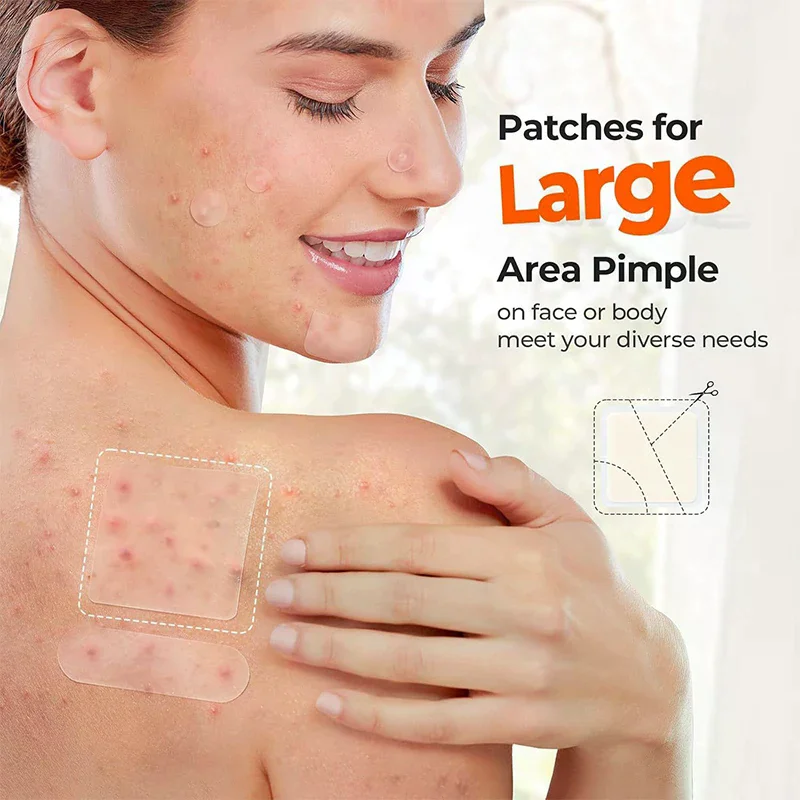 Hydrocolloid Invisible Acne Patch - Fade Acne Suction Pus Removal Stickers For Face Nose Body Skin Care Blemish Treatment Patche
