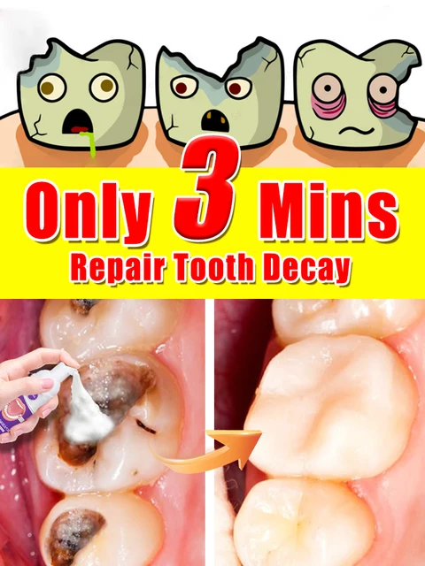 Teeth Decay repair