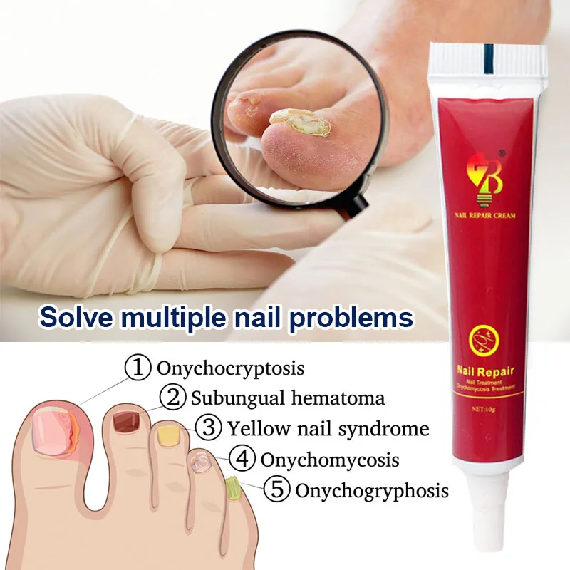 Treatment Fungal Nail Ointment Care Repair Foot Nail Fungus Removal Cream Anti Infection Paronychia Onychomycosis Product
