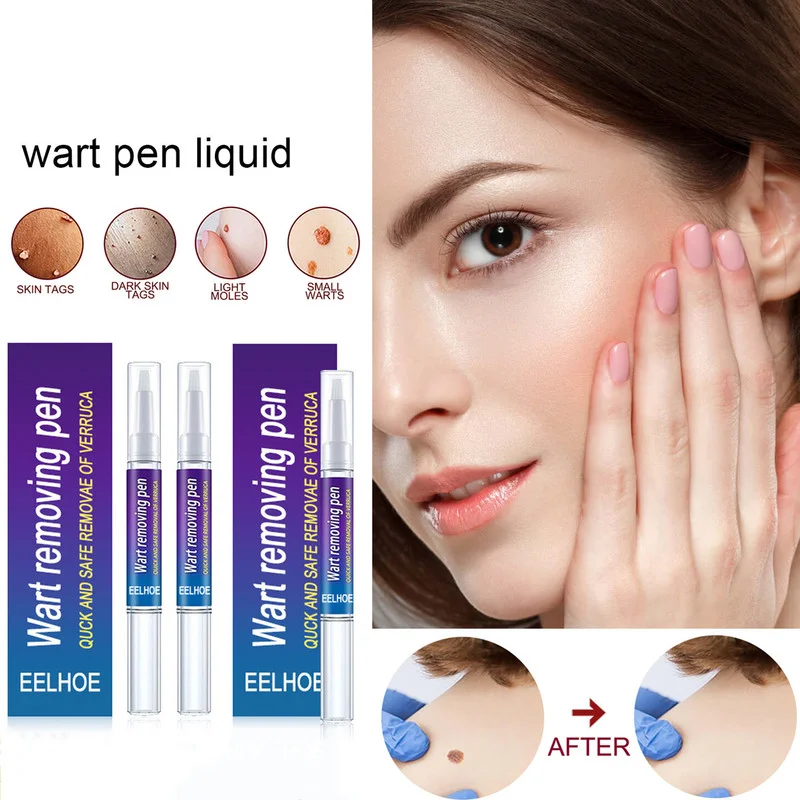 Warts Removal Pen Eliminate Wart Pen Wart Liquid Hand Foot Warts Remove
