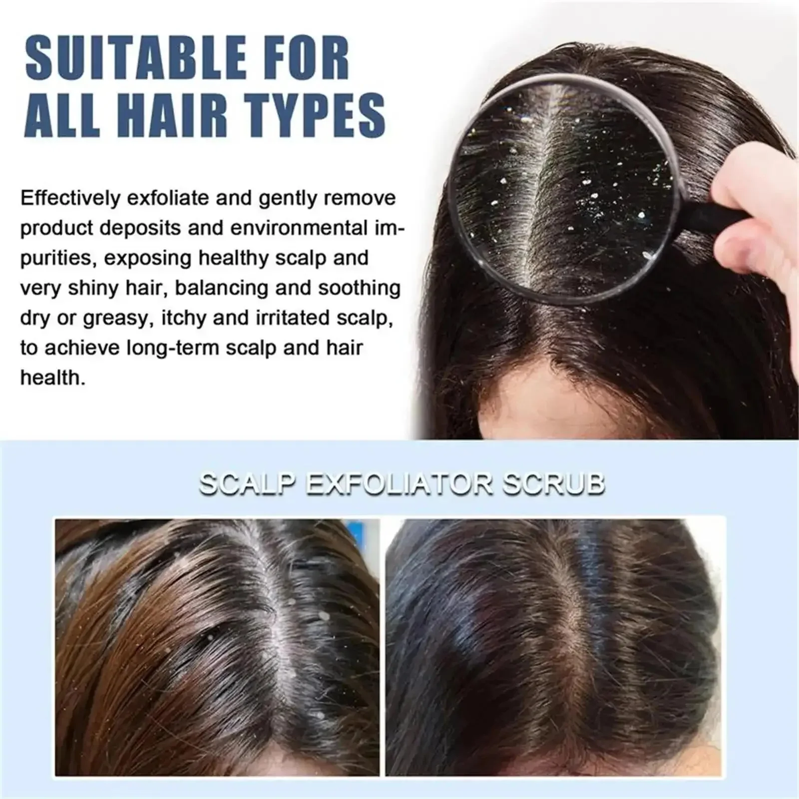 Fast Anti Exfoliating Scrub Remove Dandruff Anti Itching Treatment Seborrheic Scalp Oil Control Repair Scalp Beauty Health Care hair treatment scalp treatment