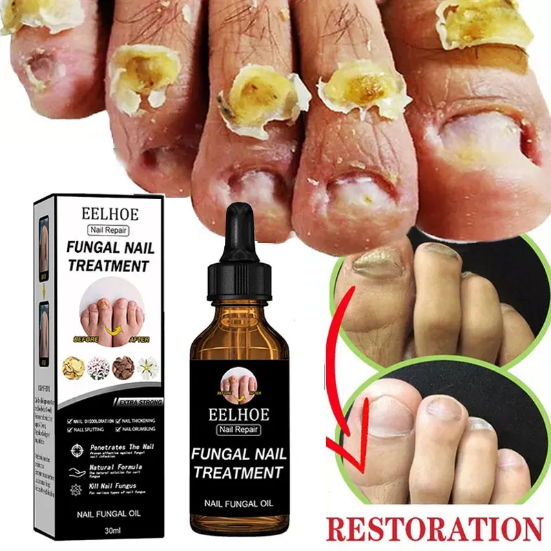 Nail Fungus Repair Liquid Remove Onychomycosis Paronychia Fungal Nail