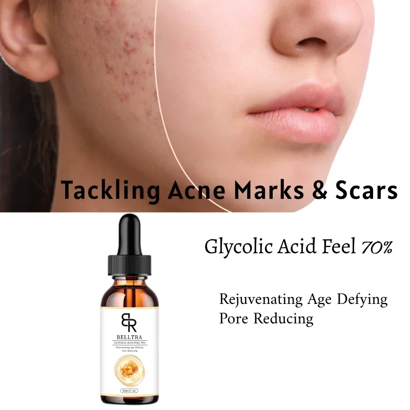 70% Glycolic Acid Chemical Peel Anti-Aging Brightening Smoothing Fine Lines Skin Pigmentation Acne Scars 30ml