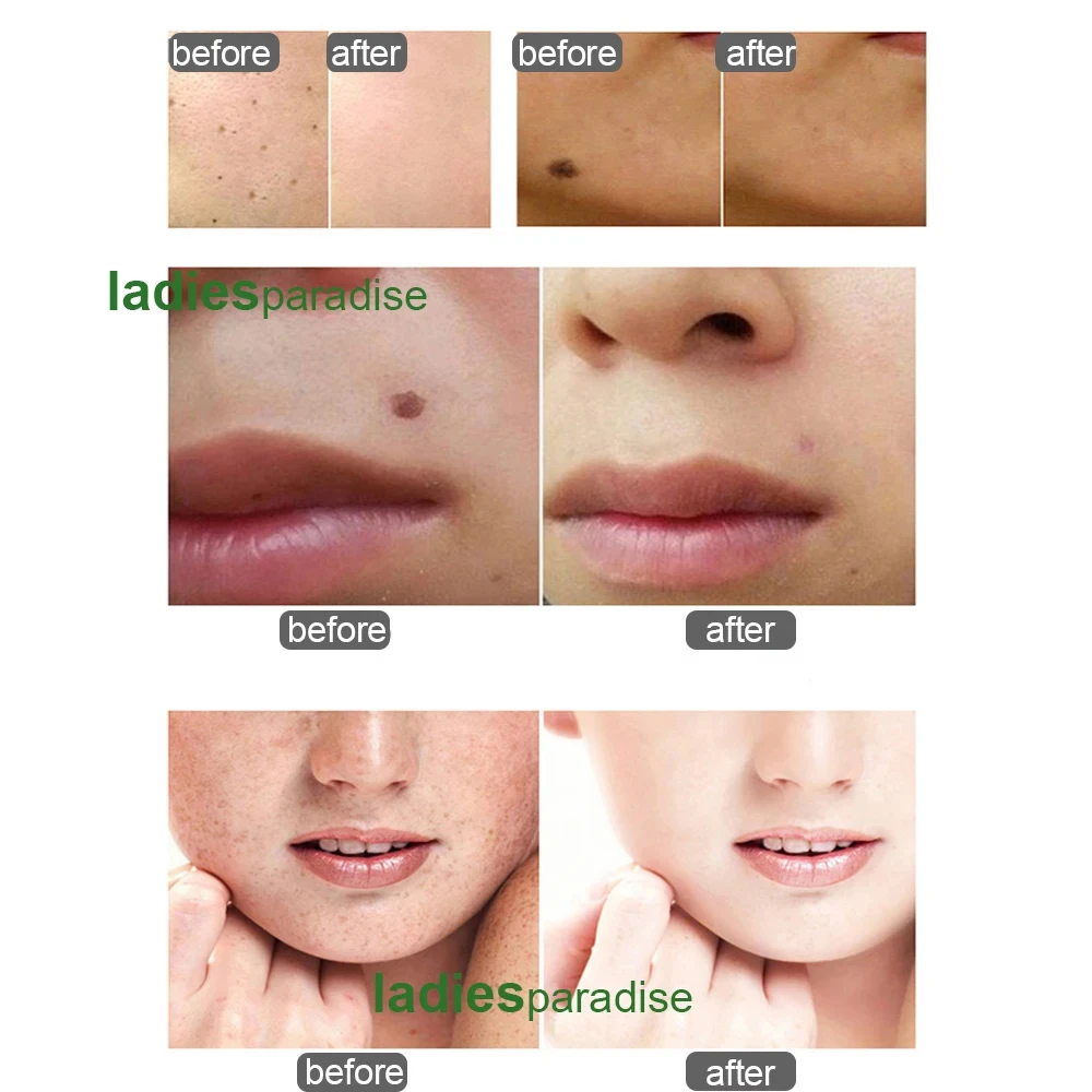 Blackhead Remover Skin Tag Removal Tool Acne Remover Laser Skin Treatment Harmless Freckle Tattoo Removal Mole Dark Spot Eyebrow Pigment Wart Acne Remover Beauty Care Replaceable Needle Salon Machine