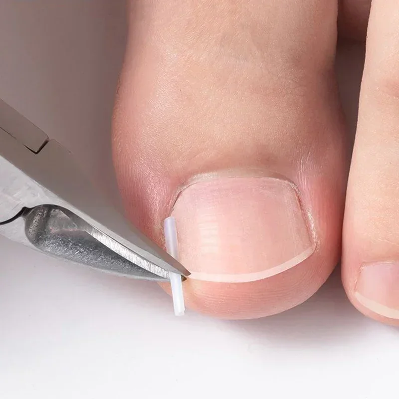 Ingrown Toenail Correction Tool Plastic Foot Care