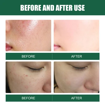 Facial Cleansing Bar Gentle Wormwood Face Wash Bar Soap Natural Herb Bar Soap Wormwood Soap Bar For Face & Body Cleaning 4