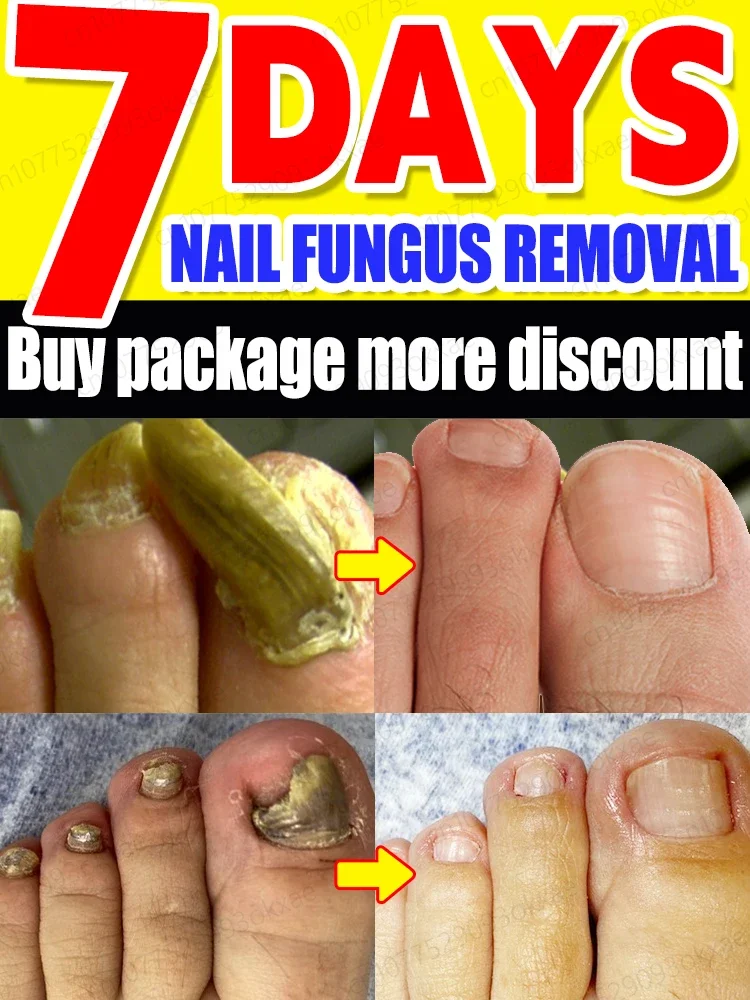 

Nail fungus Treatment Serum Onychomycosis Paronychia Anti Infection Toe Fungus Hand Foot Removal Repair Gel Care Beauty Health