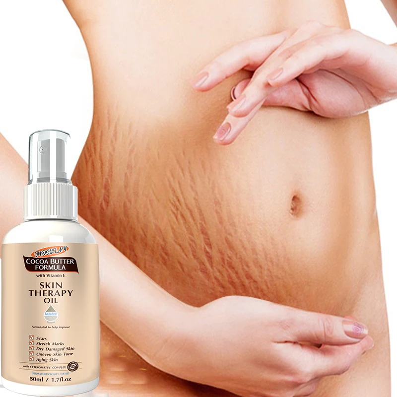 Stretch Mark Spray  Repair  Removal Acne Scar Stretch Marks Cream Fat Scar Striae Gravidarum Treatment Streaks Obesity