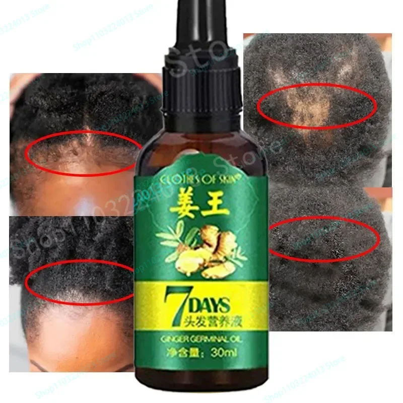 

Ginger Hair Regrowth Shampoo Hair Growth Essence Spray Hair Oil Beauty Health Hair Growth Products For Men Women