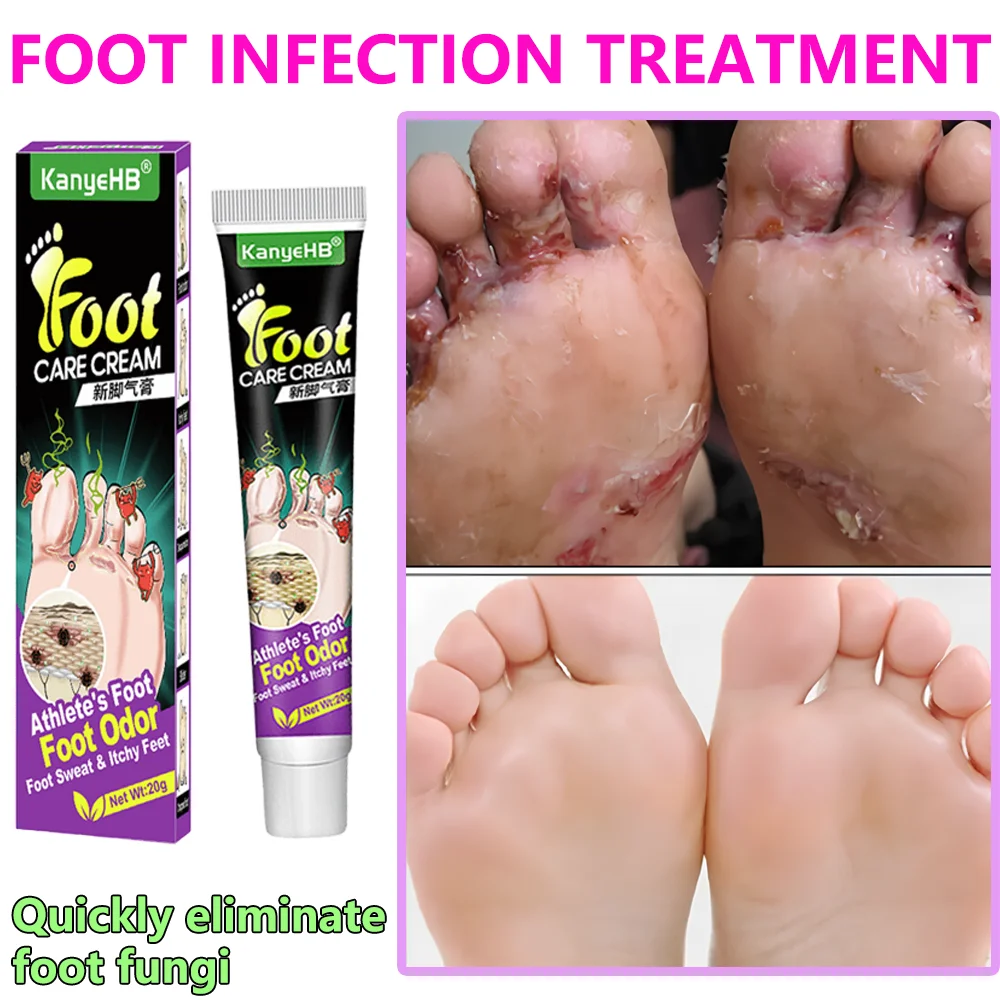 Anti-Foot Fungus Ointment Deodorant Care Products Foot Deodorant Creams Antiseptic and Antiperspirant Foot Skin Topical Cream herbal cream,varicose vein ointment,mens foot care product,anti fungal cream