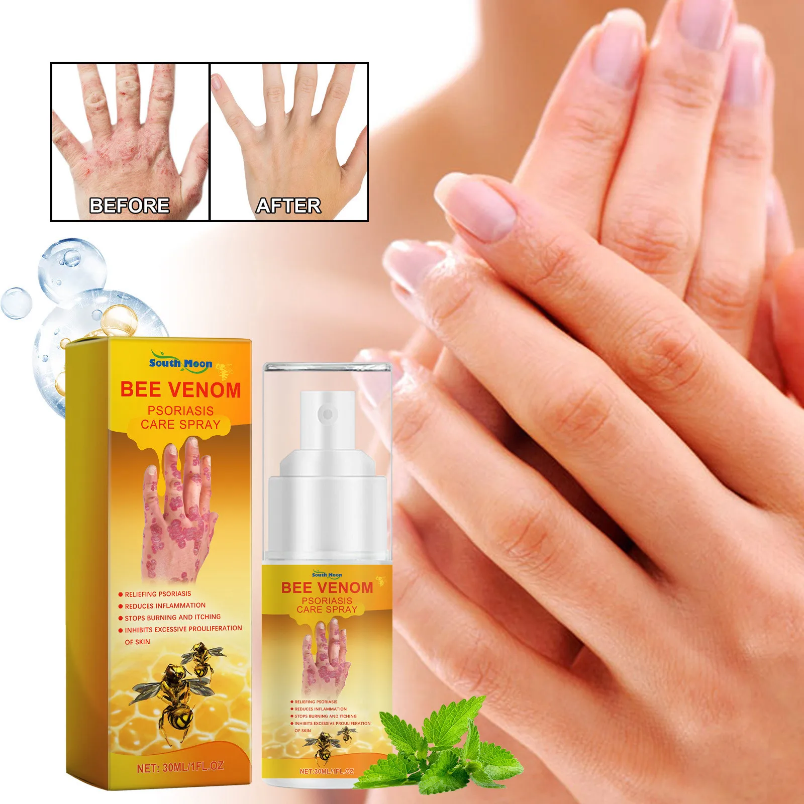 Seborrheic Dermatitis Spray Psoriasis Eczema Fungal Treatment Repair Itching Skin Redness Soothing Eczema Antibacterial Spray