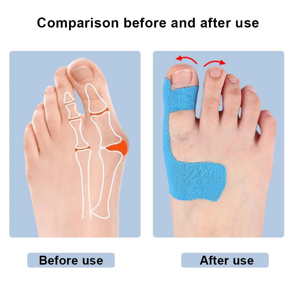 10PCS Bunion Corrector & Pain Relief Kinesiology Athletic Tape For Bunions & Turf Toe Big Toe Spacer/Separator/Straightener Tape