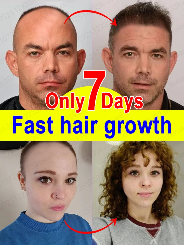Hair Treatment Oil Hair Treatment Scalp Treatment Rapid hair growth serum treating alopecia areata seborrheic alopecia hereditary alopecia etc.
