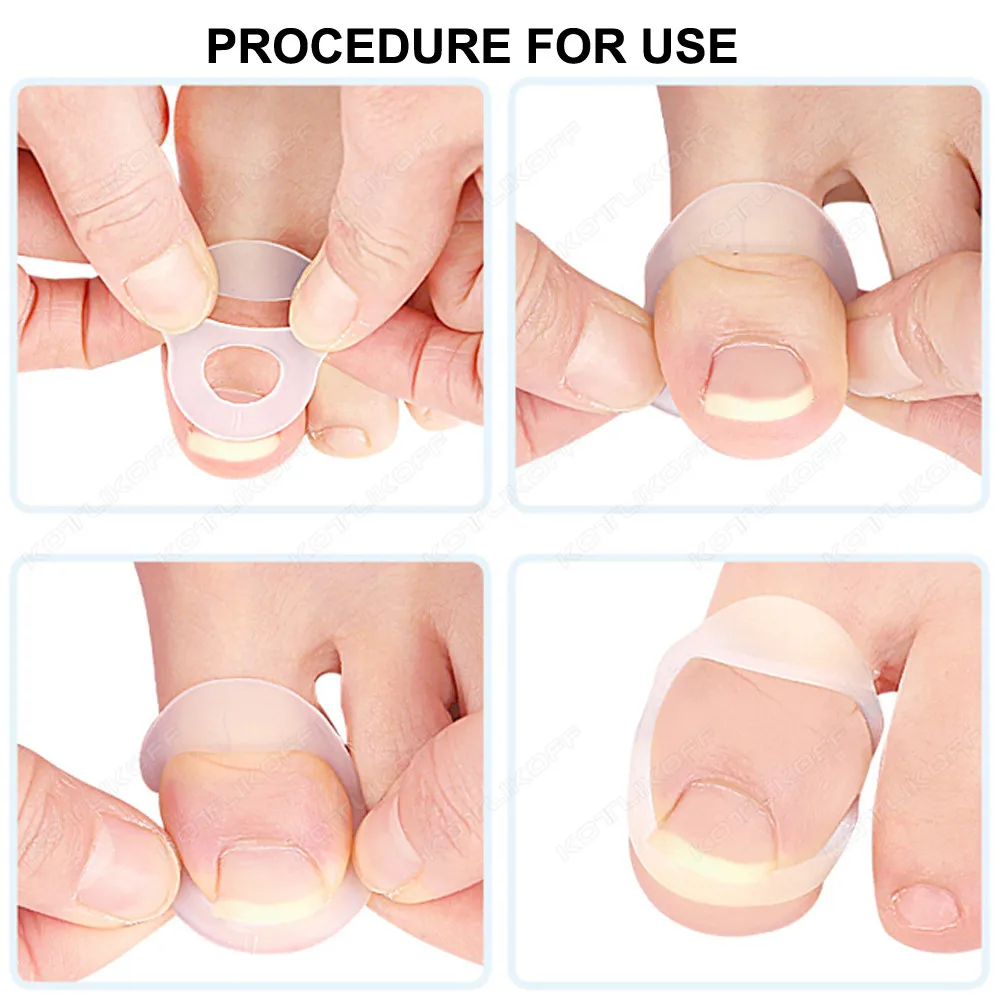 Silicone Ingrown Toenail Correction Tool Invisible Straightening Protector Durable reusable