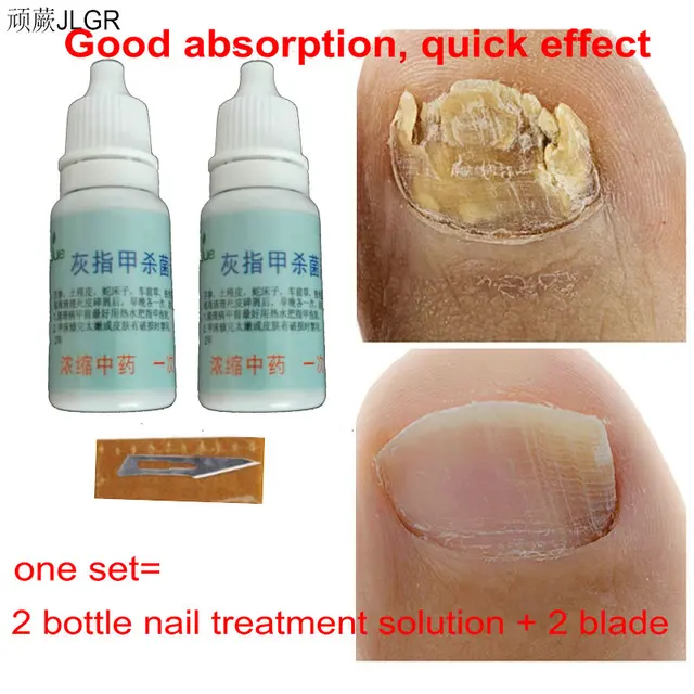 nail podiatry ingrown toenail onychomycosis antifungal for nail fungus